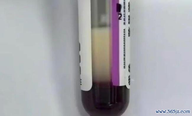 女子每天3杯奶茶 血液变乳白险丧命
